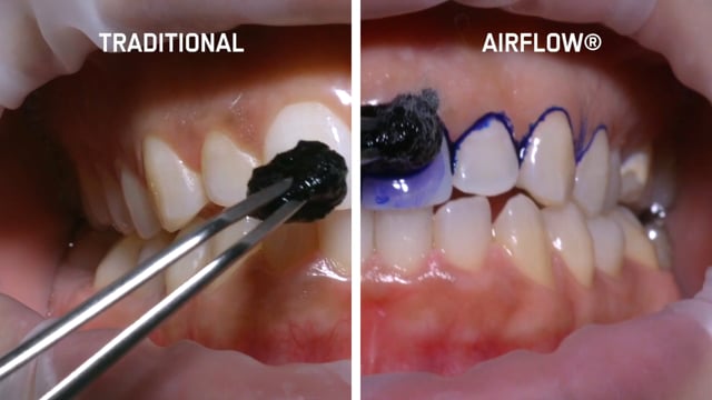 Guided Biofilm Therapy | Bells Corners Dental Studio