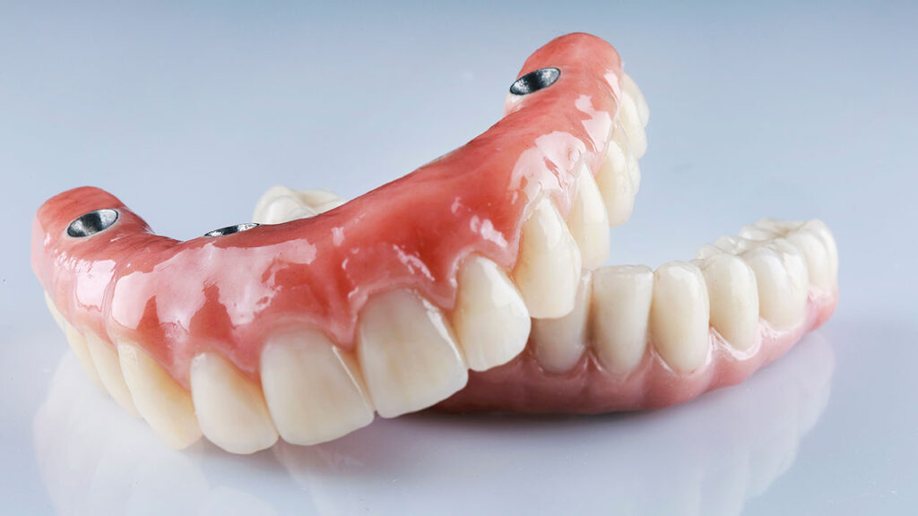  implant-retained dentures dental implants Nepean